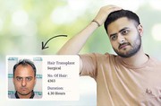 Looking for the best hair transplant in Lucknow? Dr. Amit Gupta