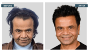 Affordable Hair Transplant Services in Gurgaon,  Lucknow,  and Noida –