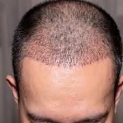 Affordable Hair Transplant Solutions in Gurgaon,  Noida,  and Lucknow